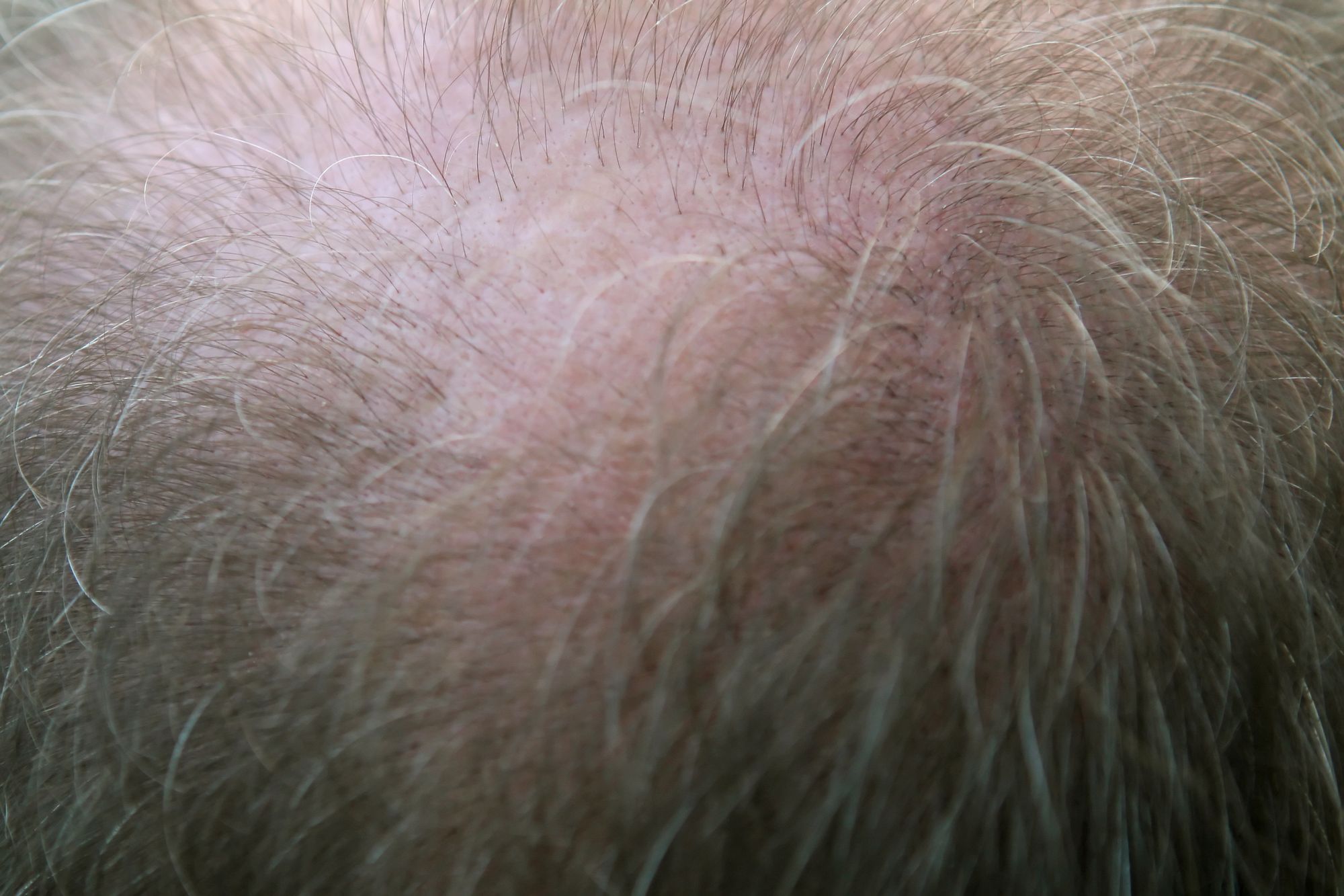 What is Alopecia - Female Pattern Baldness