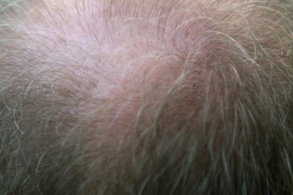 What is Alopecia - Female Pattern Baldness